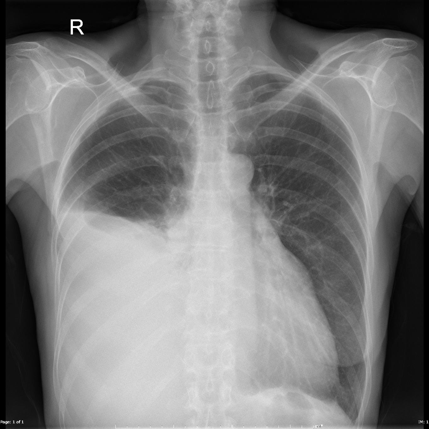 pleural-effusion-unilateral-malignant pleural-effusion-unilateral-malignant